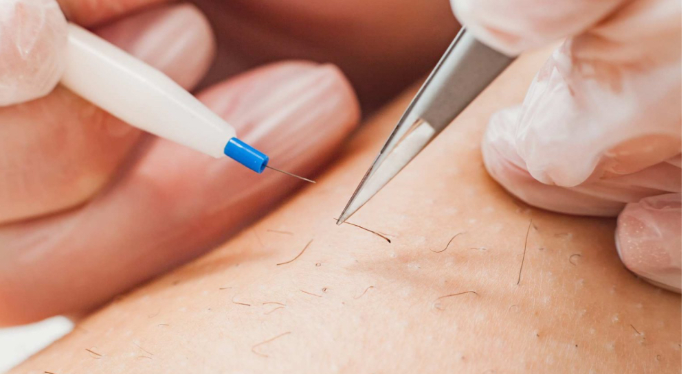 Electrolysis Needle Procedure